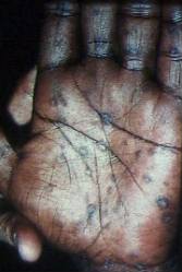 Syphilis secondaire: papules au niveau de la main