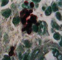 Histoplasmose américaine: coloration de Gomori-Grocott (levures)