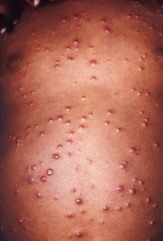 Pustules : le liquide ressemble à du pus