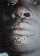 Syphilis élégante